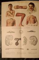 "Betegségek"  2 darab melléklet a Pallas lexikonból